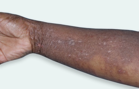 mild eczema on wrist